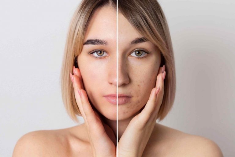 5 Unbelievable Secrets to Combat Hyperpigmentation